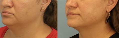 coolsculpting moonee|Coolsculpting – North Pearl.
